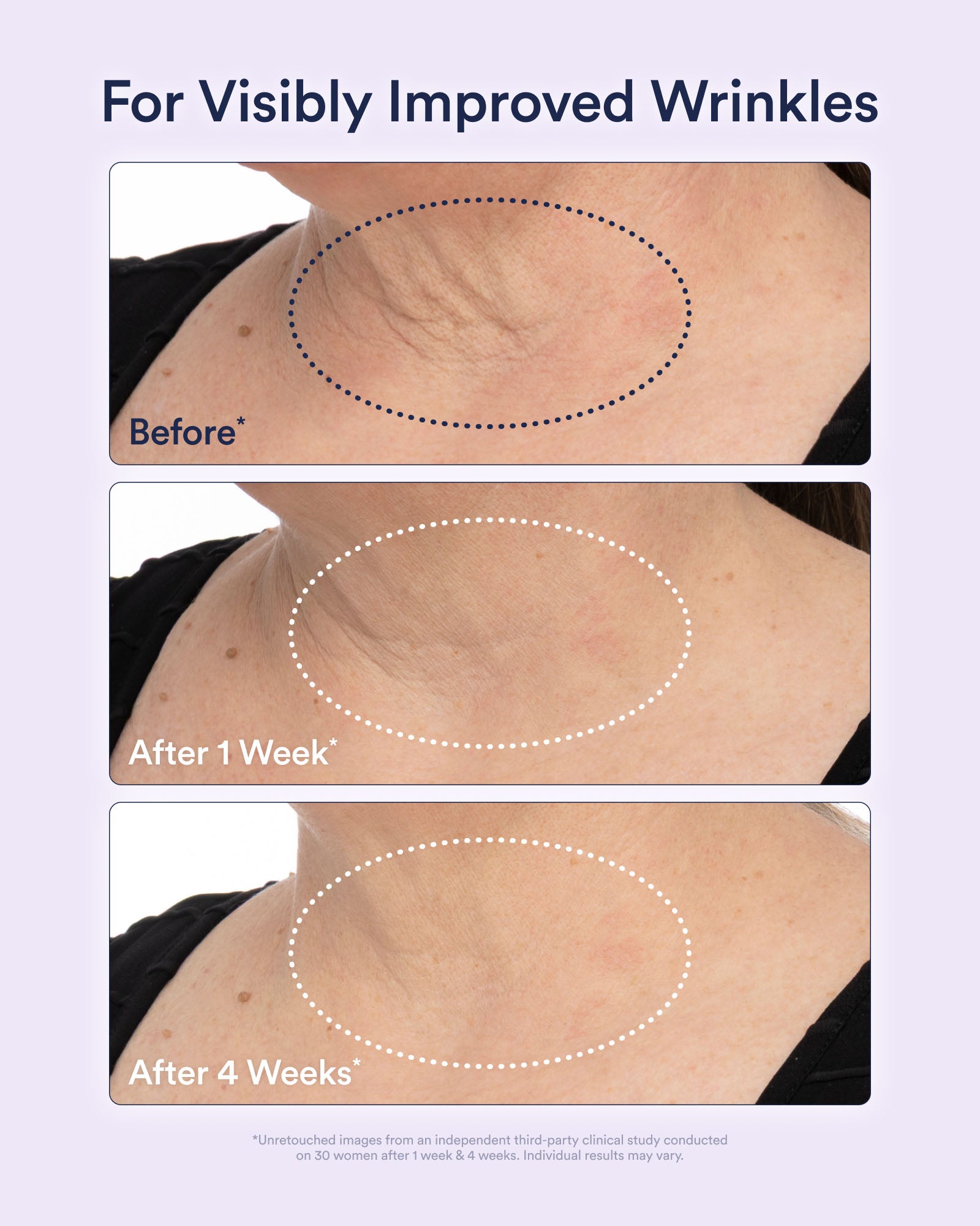 PDP_-_Clinical_Before_After_DTC_1600x2000_7c7290e3-a538-4c41-9b55-6b80fae97a3d.jpg